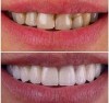 مراحل لمینت دندان + عکس