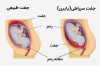 انواع جفت در بارداری (از نظر محل قرارگیری آن)